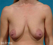 Patient # 69446 Before Photo # 1